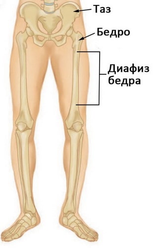 Перелом бедра фото ноги
