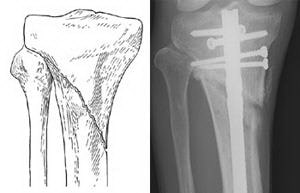 Перелом проксимального отдела большеберцовой кости