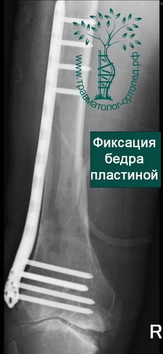 Операция при переломе костей бедра