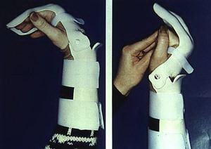 Сухожилия после перелома руки
