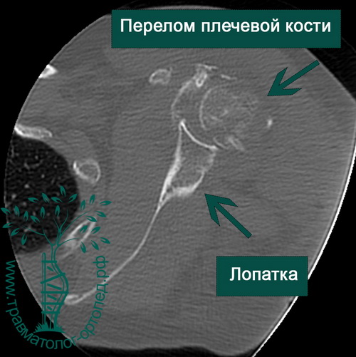 Эндопротезирование плечевого сустава артроз
