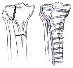 Переломы проксимального отдела большеберцовой кости