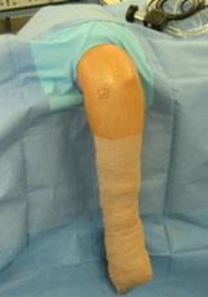 Артроскопическое лечение локтевого сустава