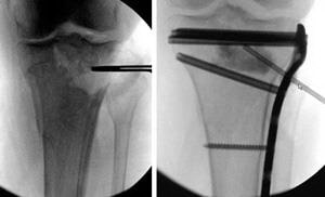Лечение переломов проксимального отдела большеберцовой кости thumbnail