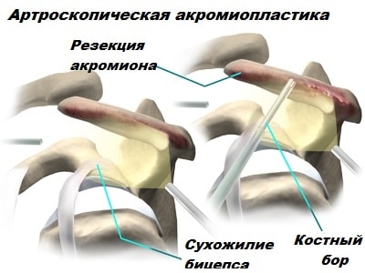 Длинная головка двуглавой мышцы плеча болит