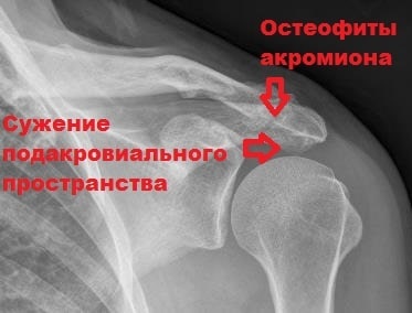 Импичмент синдром плечевого сустава какой врач лечит thumbnail