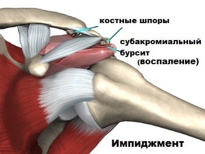 Лечение импиджмент плечевого сустава