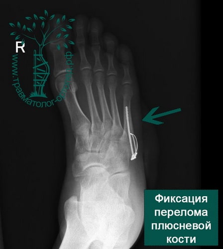 Рентгенограмма перелома плюсневых костей стопы