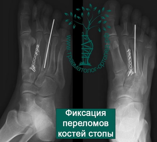 Перелом плюсневых костей и фаланг пальцев