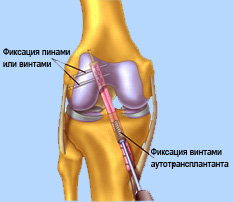Растяжение связок коленного сустава