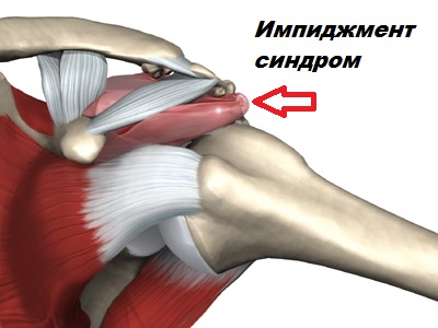Повреждение надостной мышцы плеча