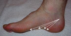 Синдром тарзального канала лодыжки фото thumbnail
