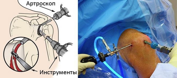 Хирургическое лечение на плечевом суставе thumbnail