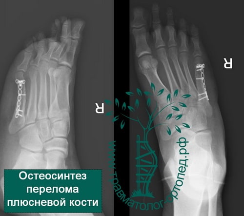 Переломы плюсневых костей и фаланг пальцев стопы