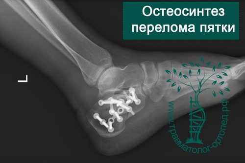 Перелом пяточной кости оперативное лечение thumbnail