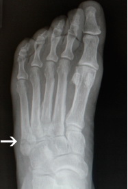 Перелом плюсневых костей пальцев