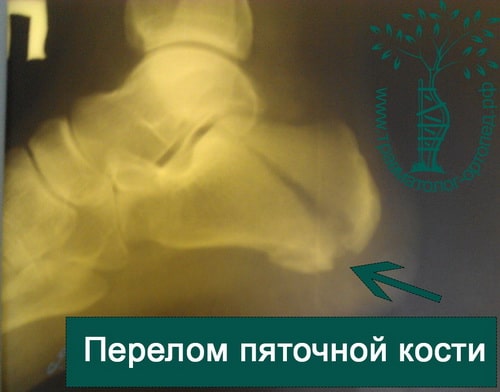 Перелом пяточной кости техника операции