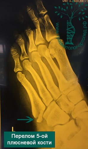 Перелом плюсневой кости 4 палец