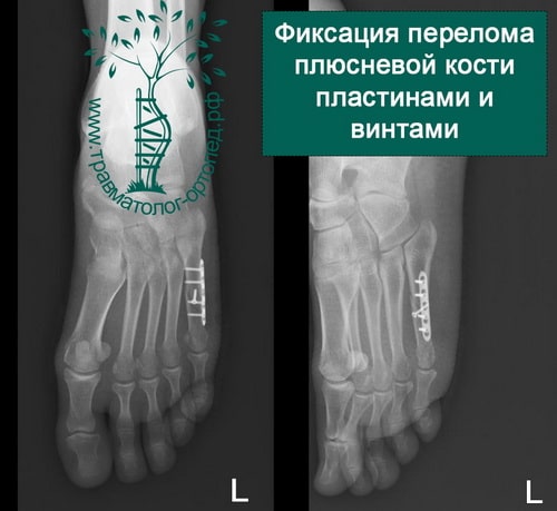 Рентгенограмма перелома плюсневых костей стопы