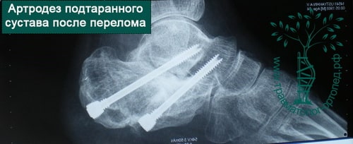 Операция при переломе пяточной кости