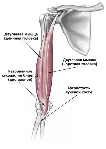 Локтевой сустав мышцы и сухожилия. Разрыв дистального сухожилия бицепса. Тендинит сухожилия бицепса тендинит бицепса. Сухожилия головки двуглавой мышцы плеча. Отрыв сухожилия бицепса от лучевой кости.