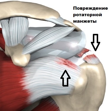 Артроз плечевого сустава импиджмент