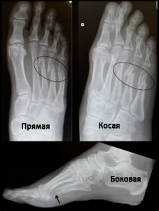 Перелом плюсневых костей классификация