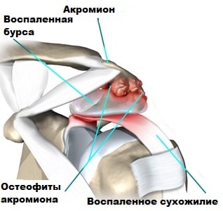 Длинная головка двуглавой мышцы плеча болит