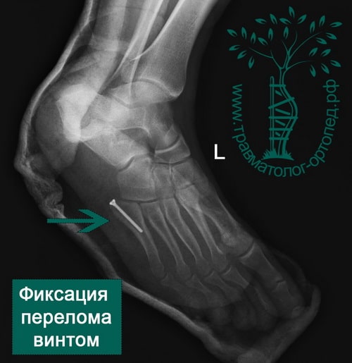 Переломы плюсневых костей и фаланг пальцев стопы