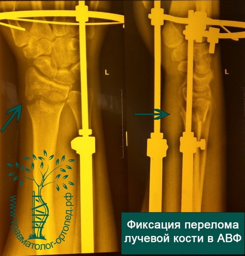 Лечение перелома дистальных отделов лучевой кости