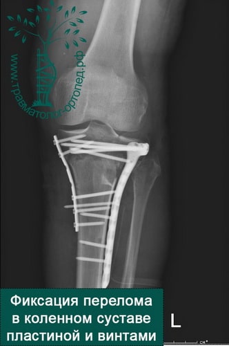 Перелом большеберцовой кости коленного сустава