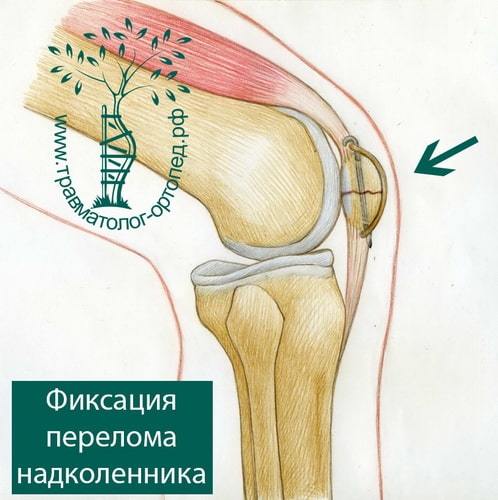 Перелом коленной чашечки ортез