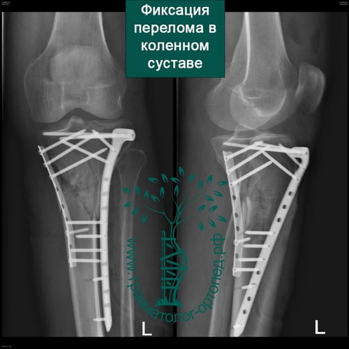 Внутрисуставной перелом большеберцовой кости коленный сустав