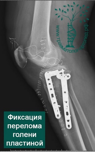 Внутрисуставной перелом большеберцовой кости коленного