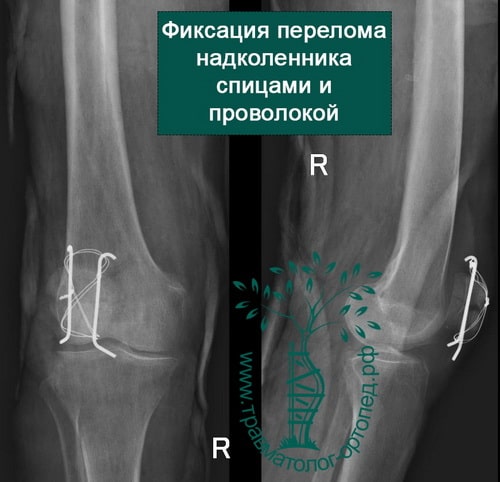 Операция при переломе колена со смещением thumbnail