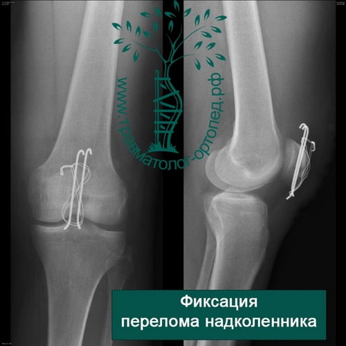 Перелом коленного сустава: клинические симптомы, механизм повреждения и лечение