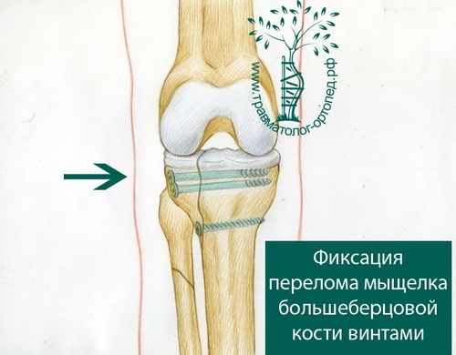 Колена внутрисуставный перелом большой берцовой кости
