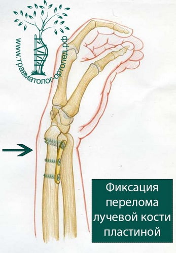 Перелом дистального отдела лучевой кости лечение