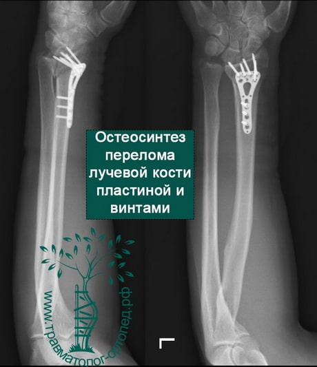 Перелом дистальной левой лучевой кости
