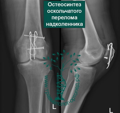 Операция при переломе колена со смещением