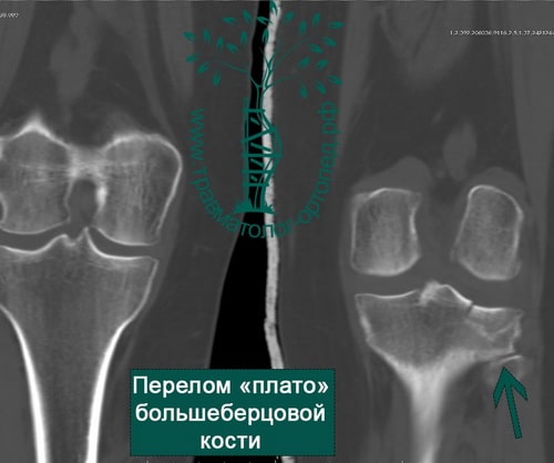 Суставной перелом берцовой кости