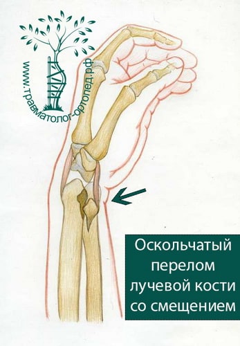 Перелом дистальной левой лучевой кости