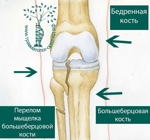 Мыщелок колена. Перелом сустава берцовой кости. Наружный мыщелок большой берцовой кости. Перелом мыщелка берцовой кости коленного сустава. Перелом мыщелка большеберцовой кости.