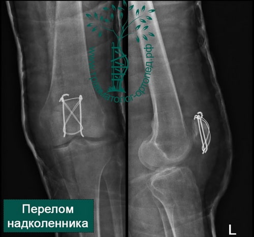 Операция после перелома колена