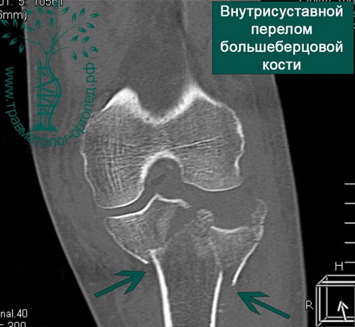 Внутрисуставной перелом большеберцовой кости коленного