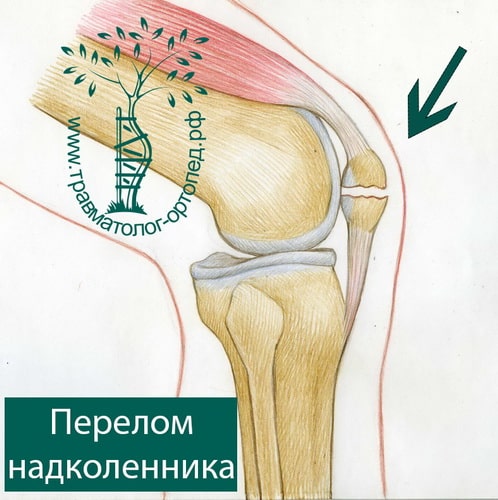 Операция после перелома колена