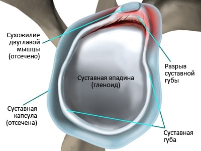 Разрыв передней суставной губы плечевого сустава лечение